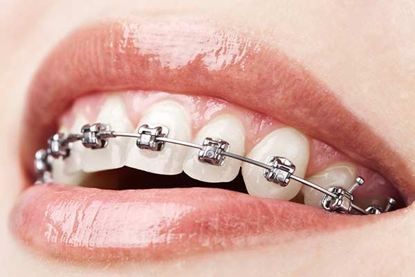 Self Ligating Bracket System