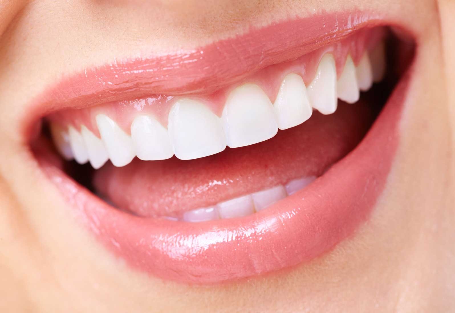 Veneers