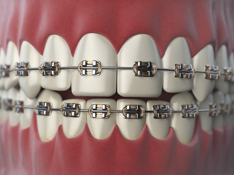 Basic Bracket System