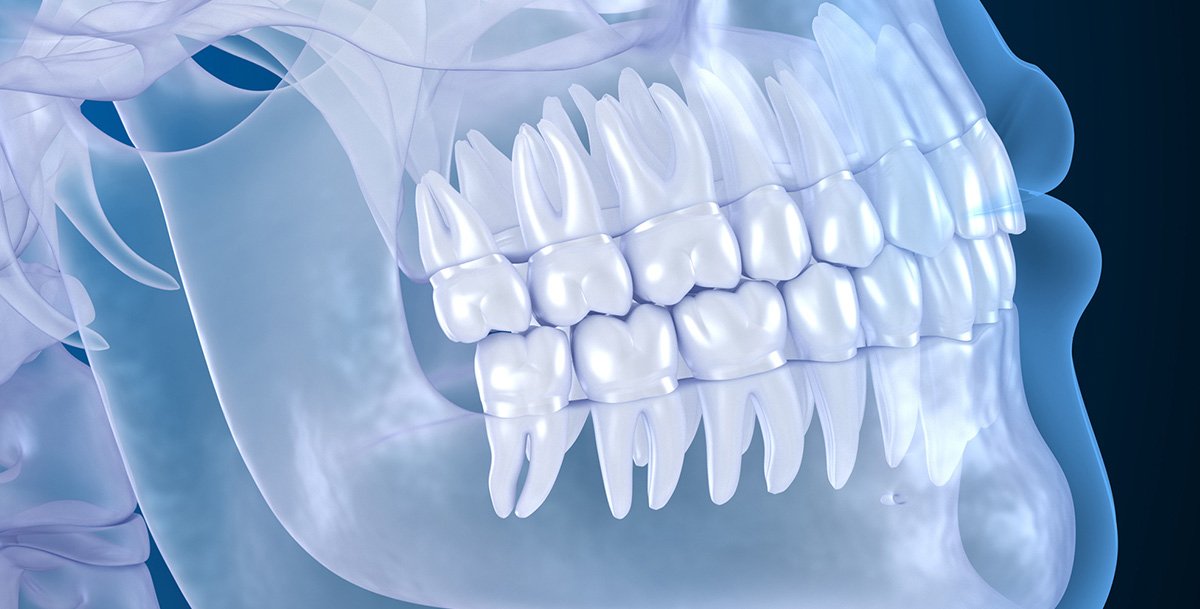 CBCT Dental Implant