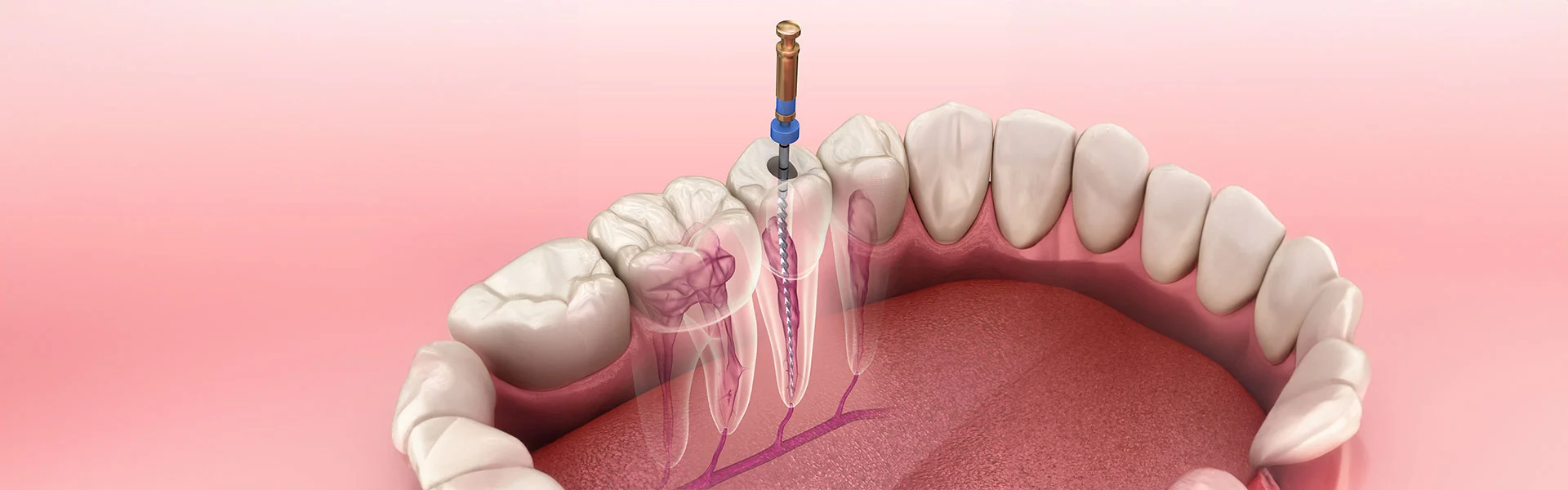 Multi-Visit Root Canal
